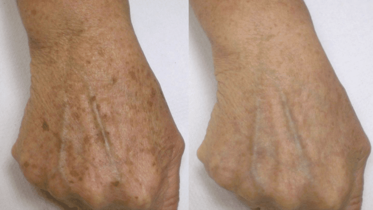 laser-dark-spot-removal-sculptdtla-com