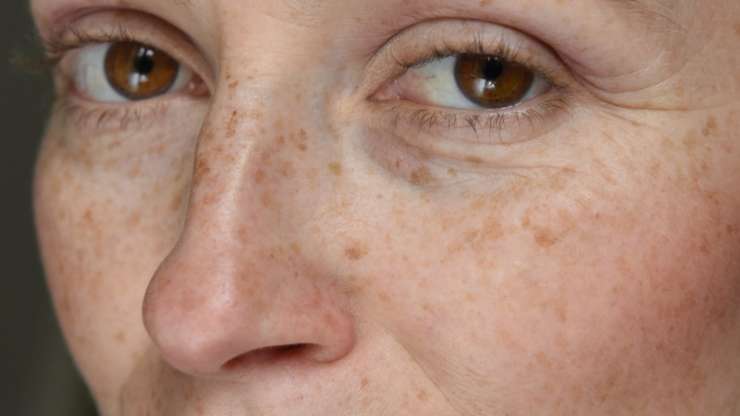 Dark Spot Laser Treatments