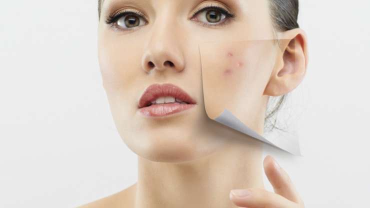 Laser Acne Treatment in Los Angeles: Working Wonders on Acne Imperfections