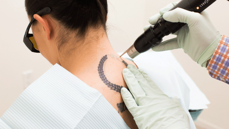 7 Frequently Asked Questions about Laser Tattoo Removal