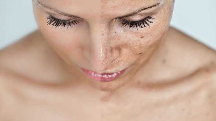 Treating Dark Spots in Los Angeles