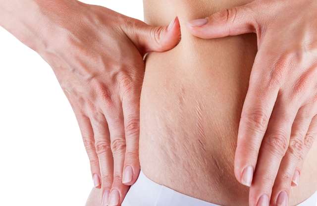 Causes, Risk Factors and Symptoms for Stretch Marks