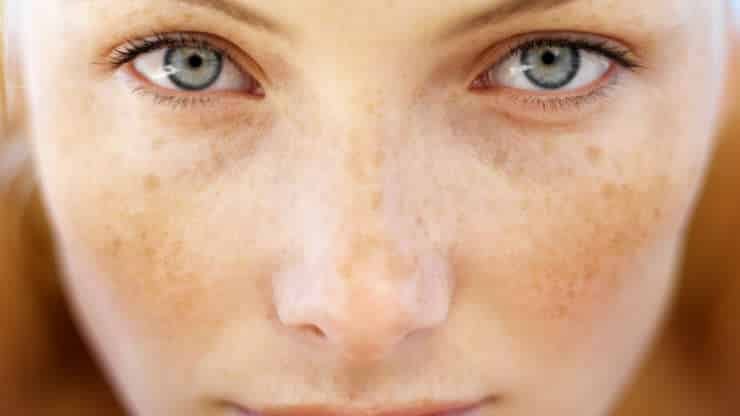 Sculpt Difference between Freckles & Sunspots