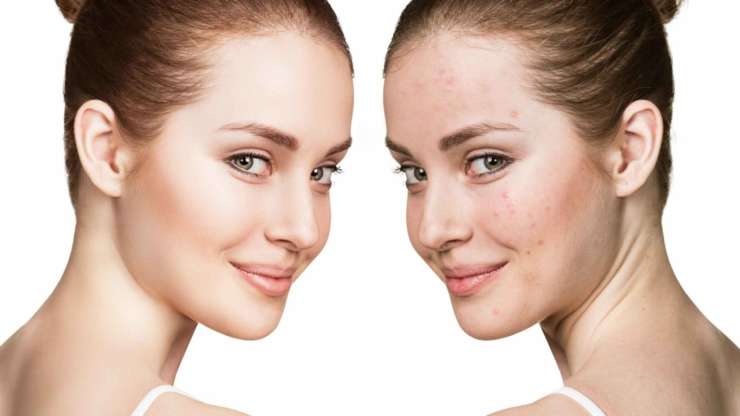 Discover The Best Treatments For Acne Scarring