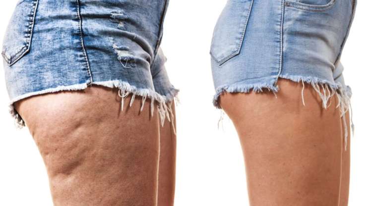 Symptoms And Causes Of Cellulite