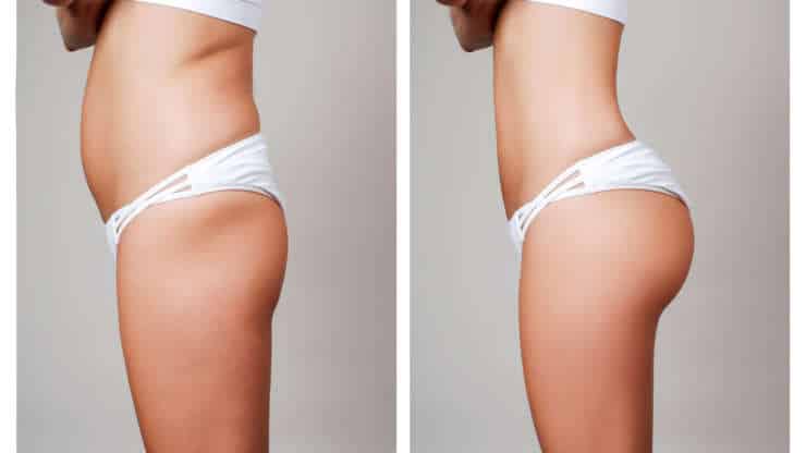 The Difference Between Sculptra Butt Lift and Brazilian Butt Lift