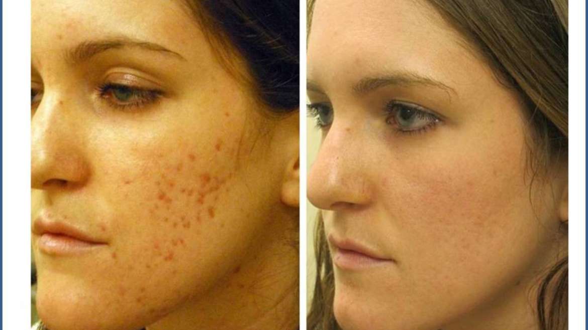 Acne Scar Treatment