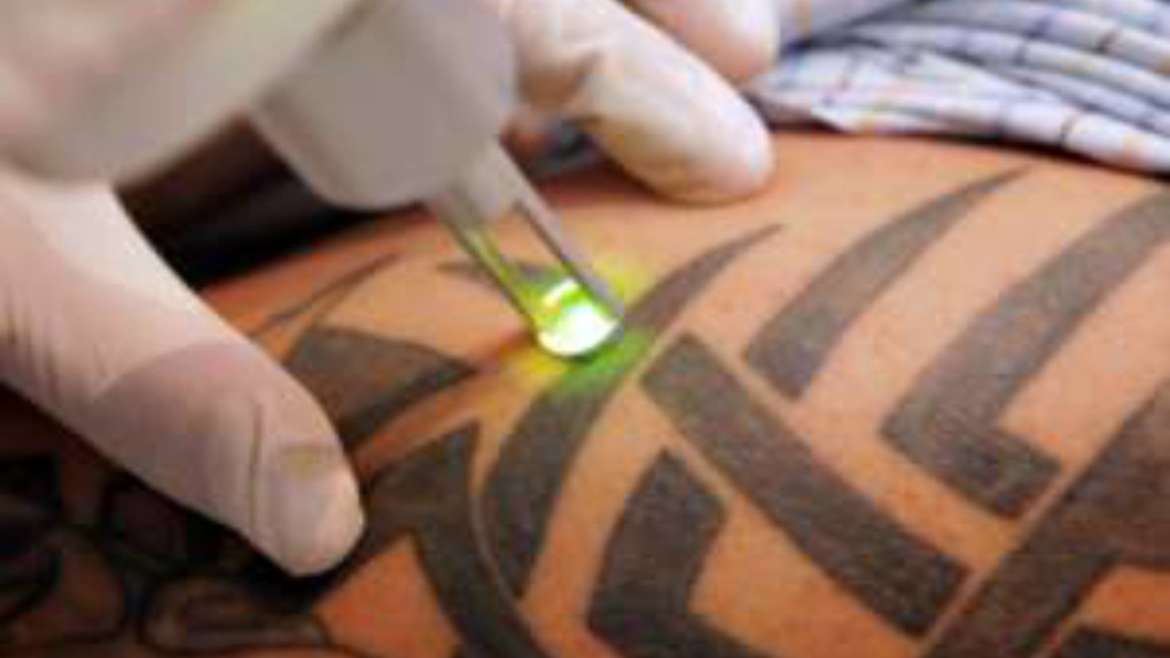 tattoo removal treatment