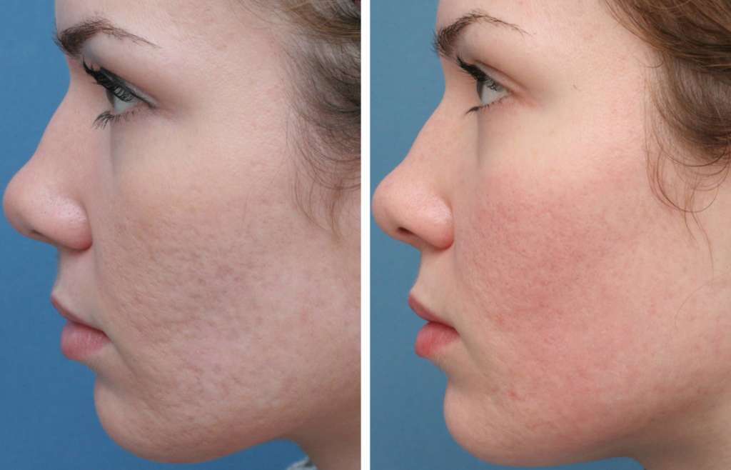 laser-acne – SCULPTDTLA.COM