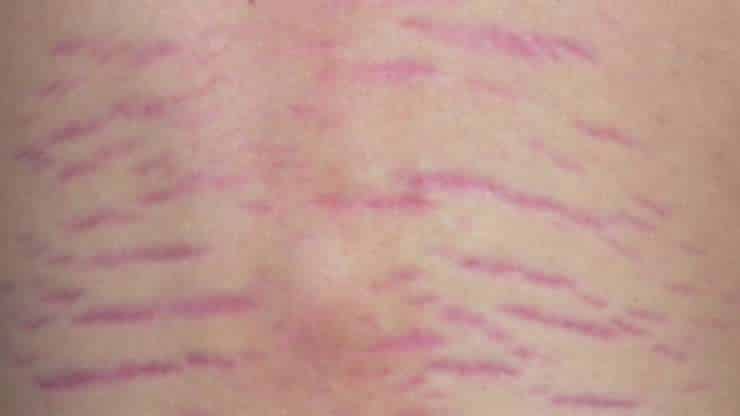 The Difference Between Red and White Stretch Mark