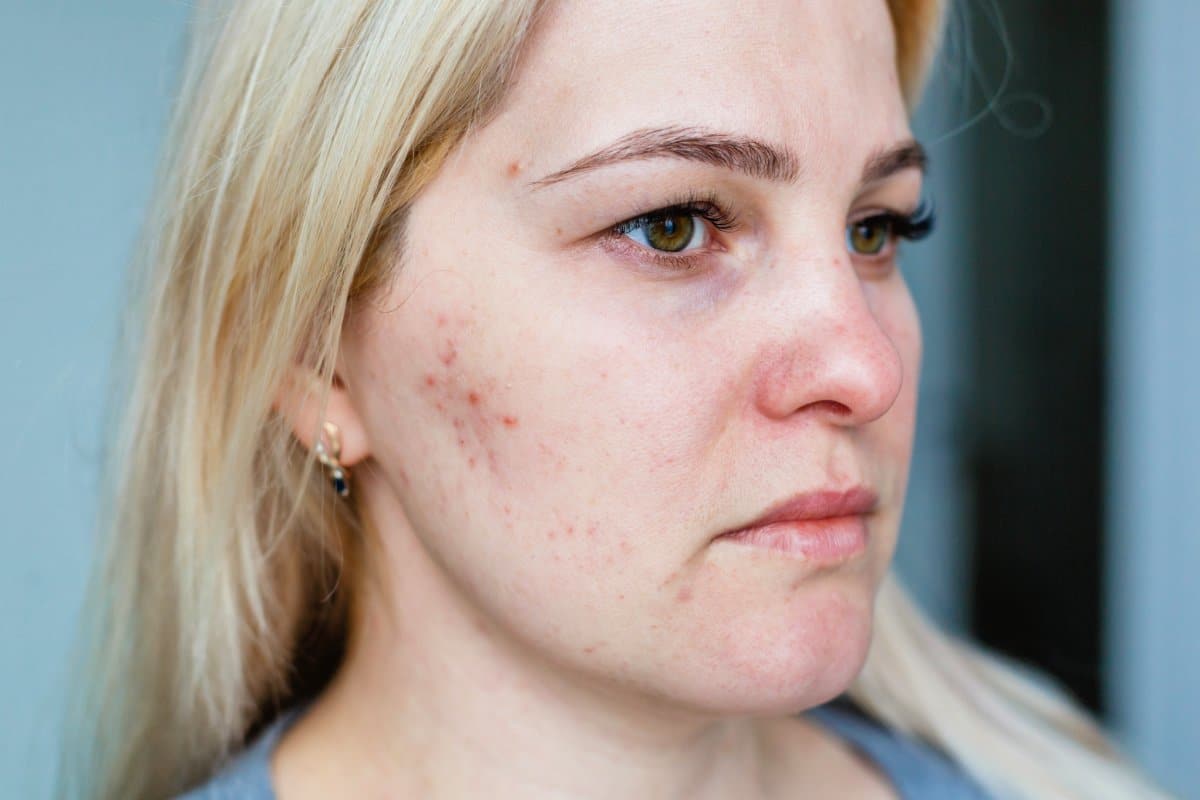 Laser Acne Treatment – SCULPTDTLA.COM