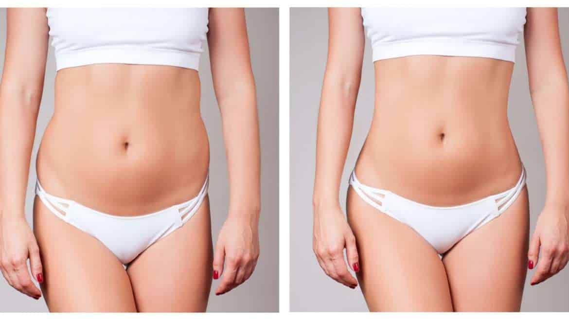 Coolsculpting Your Love Handles Flanks SCULPTDTLA COM