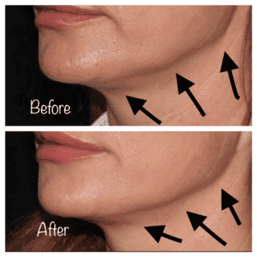 Can Botox Lift Jowls? - SCULPTDTLA.COM