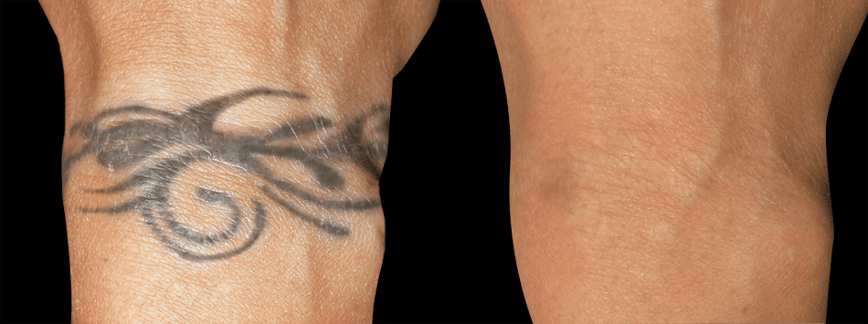 How Long Does Laser Tattoo Removal Take To Heal SCULPTDTLA COM