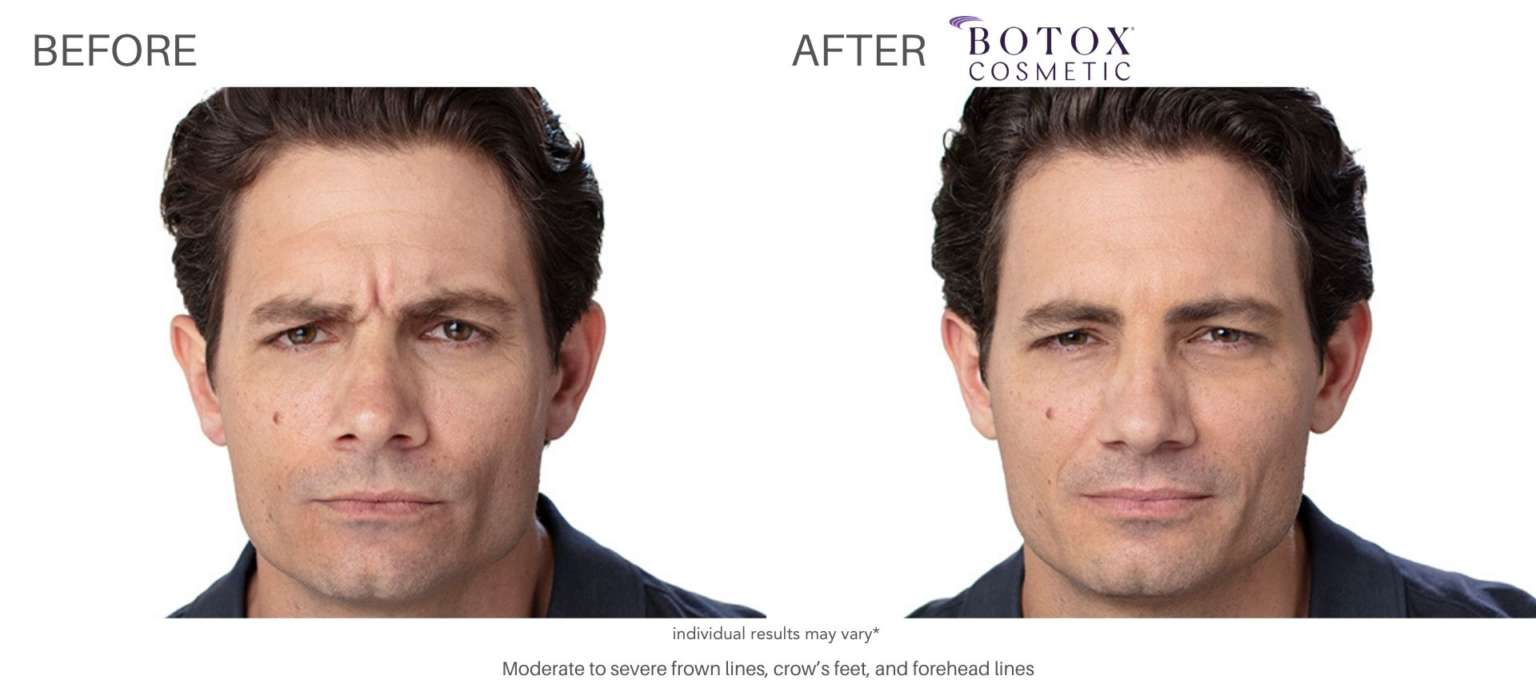 BOTOX: ANTI-AGING TREATMENTS IN LOS ANGELES