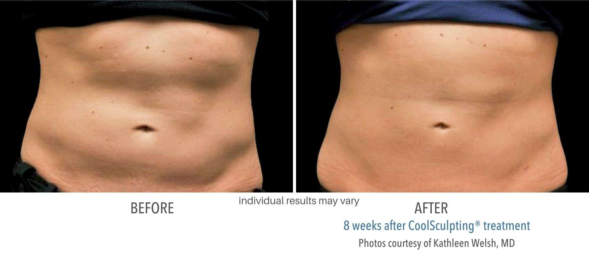 Coolsculpting Before and After Photos
