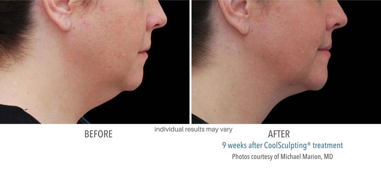 Coolsculpting Chin Eliminate Double Chins And Tighten Skin Sculptdtlacom