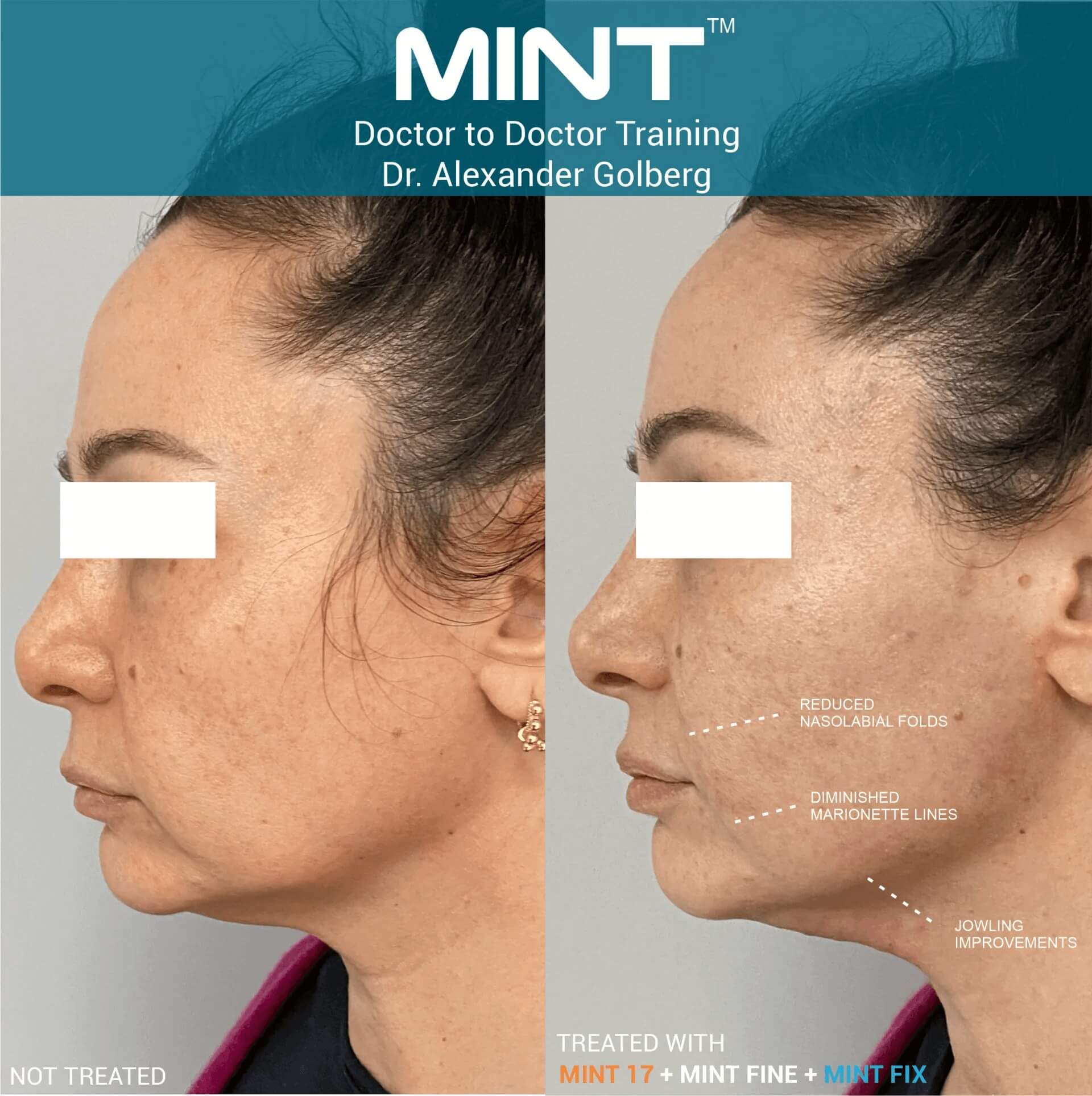 PDO Thread Lift | Sculpt Med Spa
