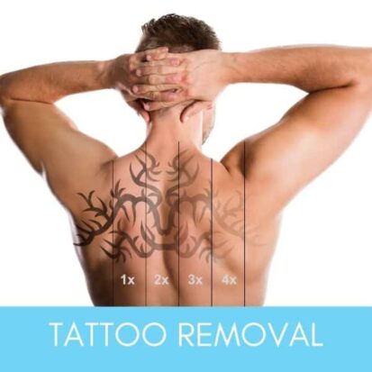 Mans tattoo on his back showing the progress and process of tattoo removal treatment.
